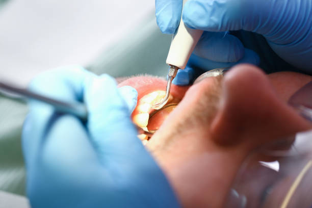 Best Knocked-Out Tooth (Avulsed Tooth) Treatment in South Kensington, MD
